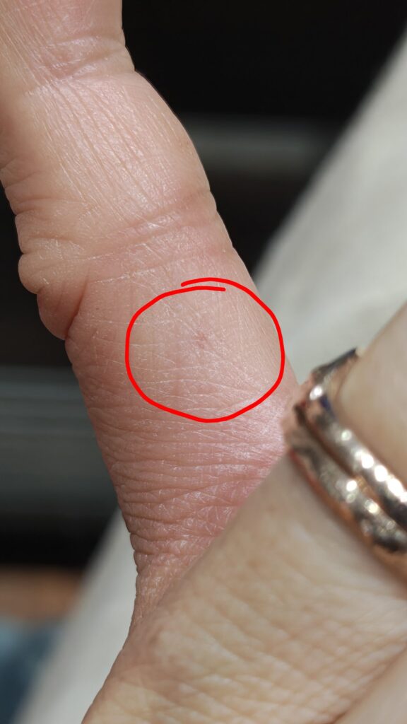 bee-sting