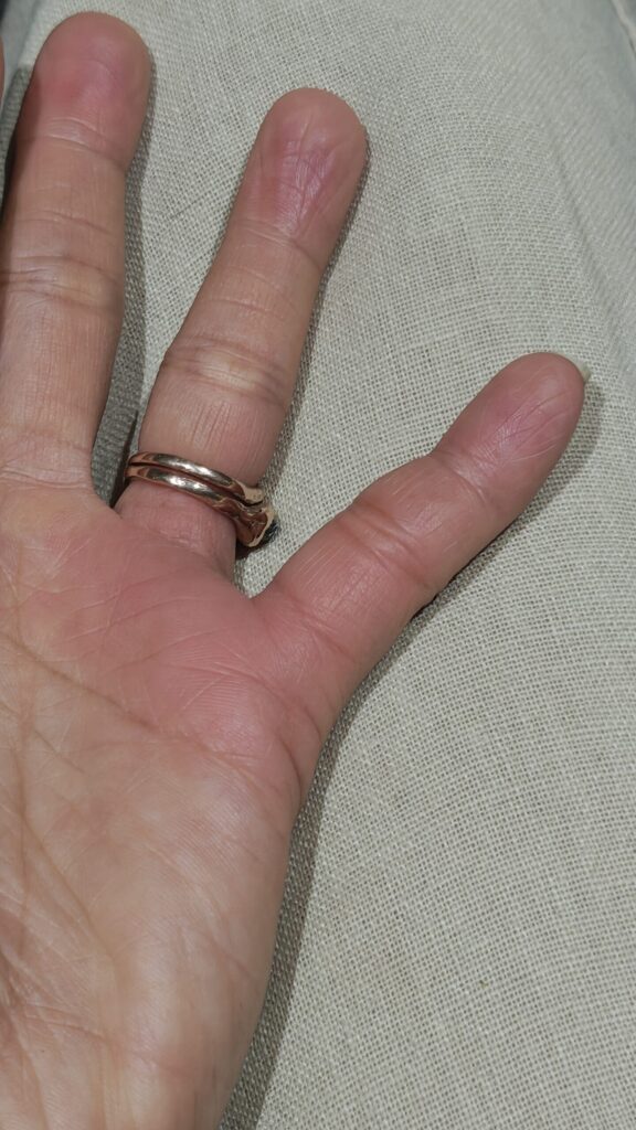 swollen-hand