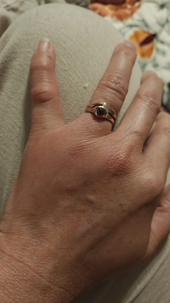 swollen-hand2