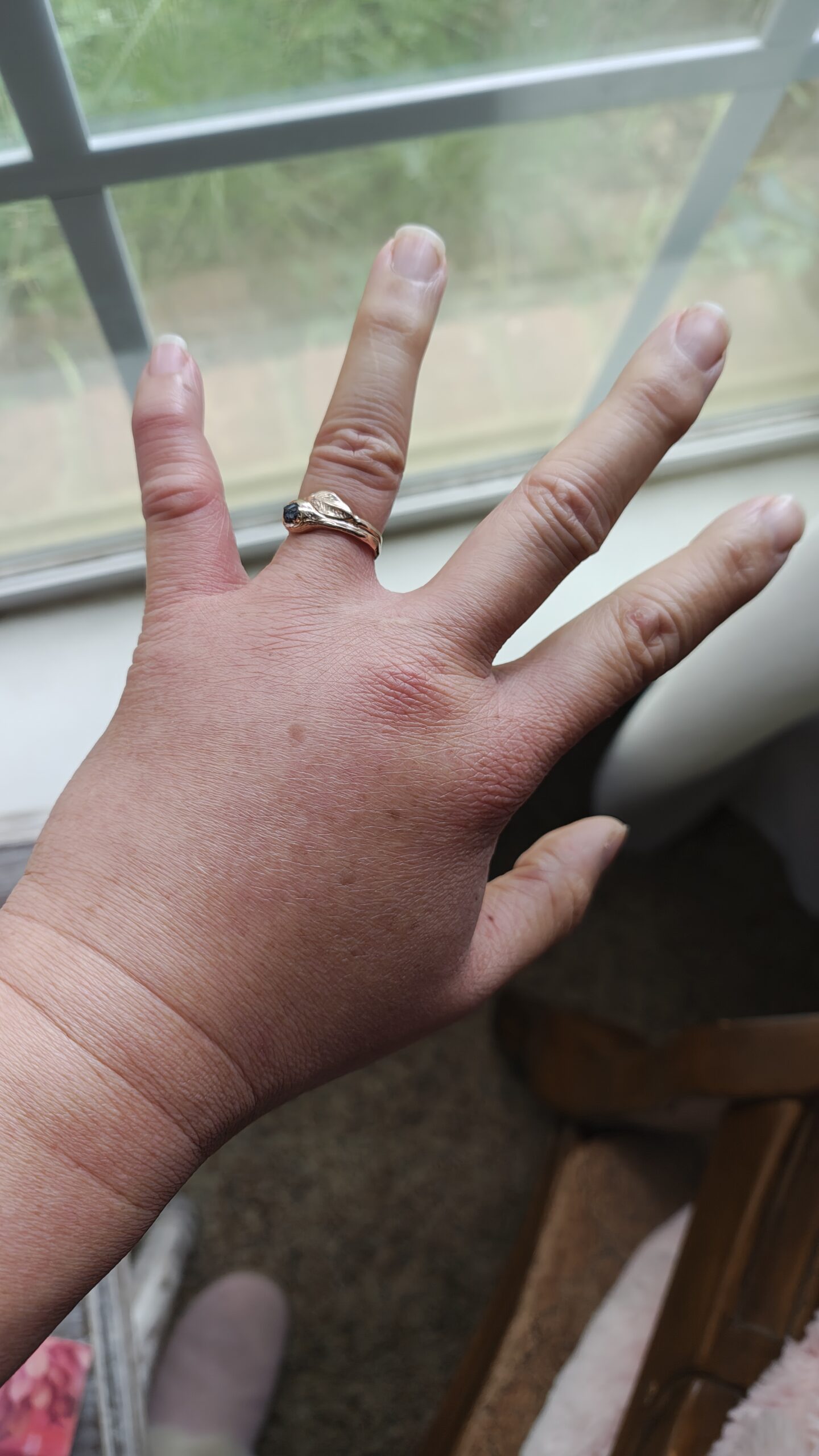 swollen-hand3